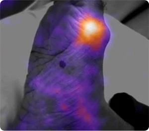 Seracam spot image showing focal uptake in the metatarsal head/ball of the right foot - image courtesy of University of Malaya Medical Centre